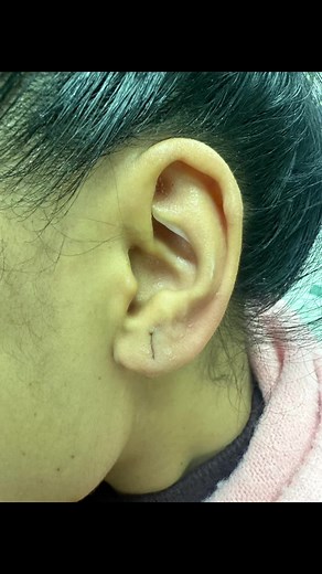 How to Recover Stretched Earring Holes Without Surgery - Safe & Painless Procedure