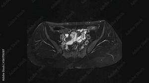 MRI of the female pelvic organs, abdominal cavity, gastrointestinal tract and bladder