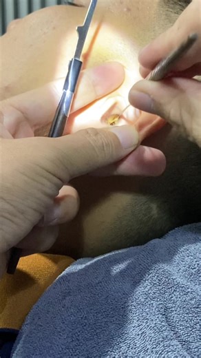 #ear #cleaning #asmr #earcleaning