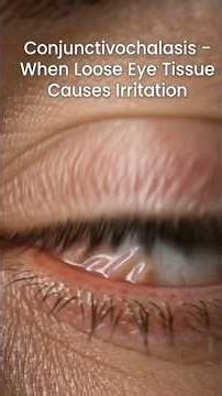 Why Your Dry Eye Drops Aren't Working! (Understanding Conjunctivochalasis)