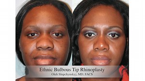 African American Bulbous Tip Rhinoplasty: The Doctor Explains and Performs the Procedure  (GRAPHIC)