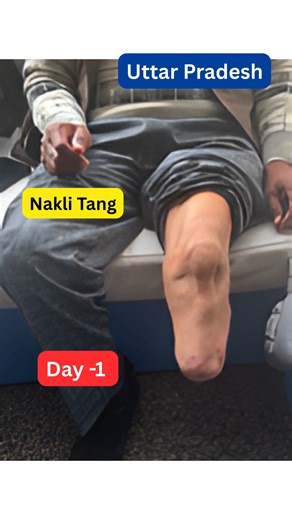 Below Knee Prosthetic Leg | Day One Walking | Patient from Uttar Pradesh In this video, we share the successful rehabilitation journey of a patient from Uttar Pradesh who had a Below Knee Amputation. He visited Ideal Artificial Limbs Solution, Delhi, where he was fitted with a customised Below Knee Prosthetic Leg. The most inspiring part of this case is that the patient was able to walk very well on Day One itself. With proper socket fitting, correct alignment, and advanced suspension system, he