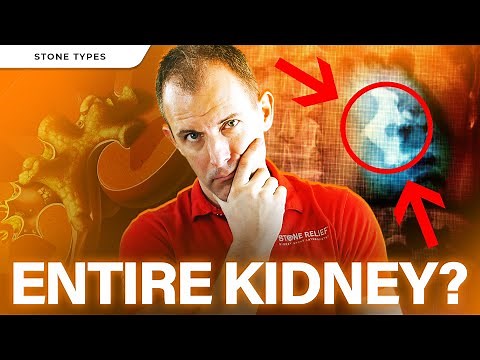 Staghorn Kidney Stones: Causes, Treatments, Prevention, and Diet Tips