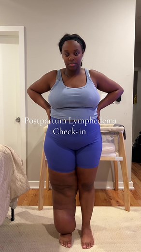Managing Postpartum Lymphedema: A Personal Journey