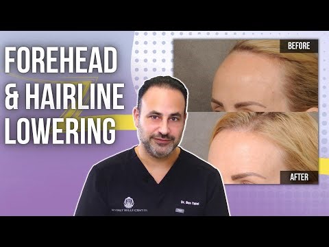 Forehead Lowering Lesson of the Day