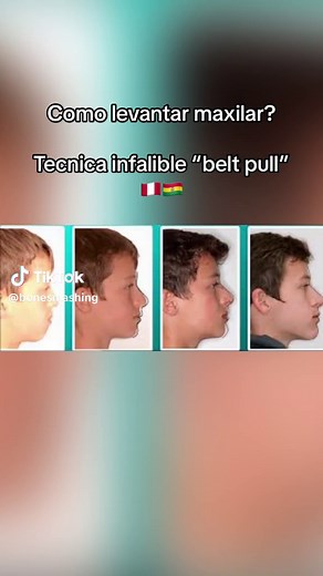 #mewing #looksmaxing #looksmax #psl #chicolachowski #jordanbarrett #maxilar #bonesmashing #mrmandibulas