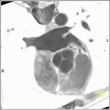 4D Imaging of the Aortic Valve 3D and 4D rendering of the heart (2 of 3)