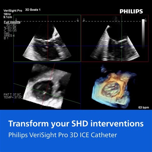 VeriSight Pro 3D ICE Catheter