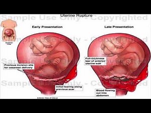 Uterine rupture