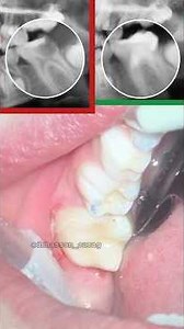Vital Pulp Therapy on a lower molar of a 9 year old child