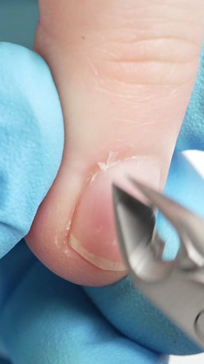 How to Remove Hangnails Easily and Safely