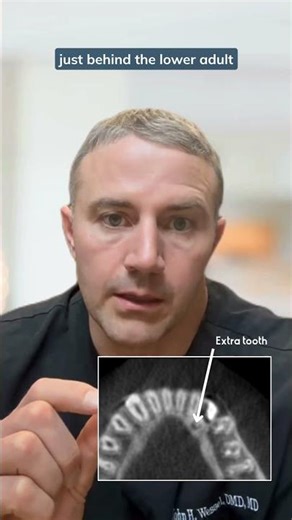 How CBCT Imaging Uncovered a 3mm Extra Tooth