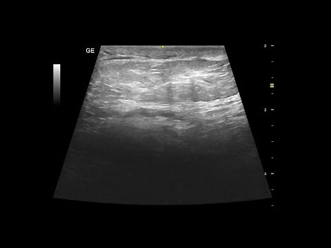 Spermatic Cord Lipoma | Ultrasound Case | GU |