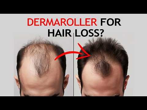 Dermaroller to Reverse Hair Loss - Ultimate Guide for Beginners