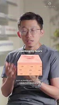 Treating Acne Scars | PART 1 | #acnescars #acnetreatment #acne