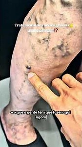 Tratamento de varizes grossas com resultado É POSSÍVEL SIM⚠️ #varizes