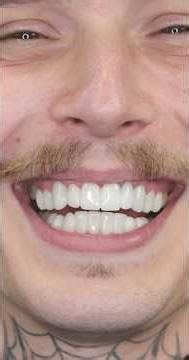 From Shattered Teeth to Perfect Smile 😱🦷