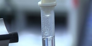 Medical Moment: The blood test detecting pancreatic cancer early