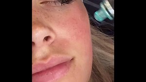 SUCTION SATISFACTION.  The HydraFacial Vortex technology works to painlessly extract all of the dirt, oil, and gunk from your pores, leaving you with clean, healthy skin!  @hydrafacialuk #hydrafacial #hydrafacialuk #skincare #skinhealth #skintreatment #LVBXUK | Changes Clinic | Facebook