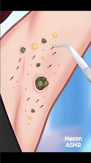 [ASMR] Armpit Blackhead Removal 💦 #asmr #armpit #blackheadremoval