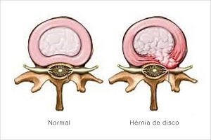 Hérnia de Disco