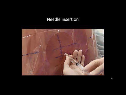 Ultrasound-assisted paraspinous/paramedian approach to spinal/epidural anesthesia