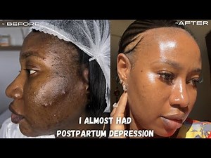 You won’t Believe This Happened to ME !!! POSTPARTUM SKIN - GLOWING 4 MONTHS LATER