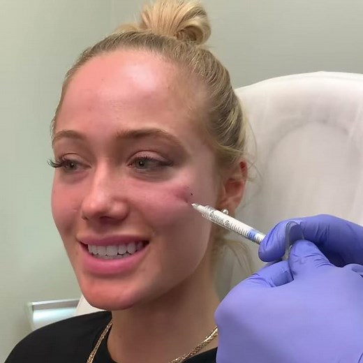 Cheek Fillers 🍎(Using Radiessse)