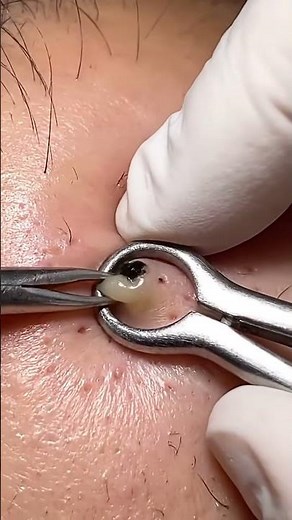 🤯 100 GIANT Blackheads POPPED! 😱 You Won't Believe This! 💥