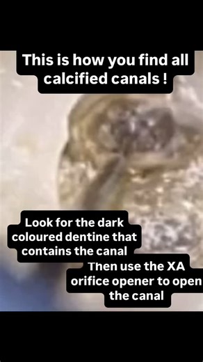 119 reactions · 11 shares | THIS IS HOW YOU FIND ALL CALCIFIED CANALS -Magnification and illumination shows you the colours and your surgical skills do the rest #endodontics #calcifiedcanal | Specialist Endo Sydney- Clinical hacks | Facebook