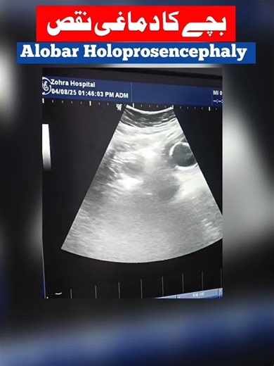 #AlobarHoloprosencephaly#Holoprosencephaly#Cyclopia#FetalBrainDefect