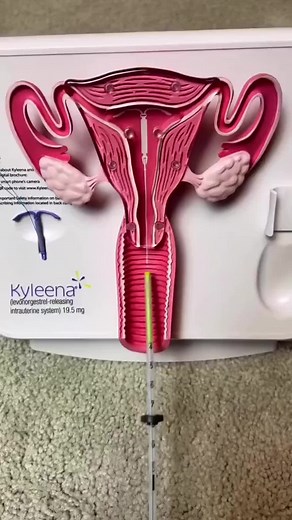 Understanding IUDs: Hormonal vs Non-Hormonal Options