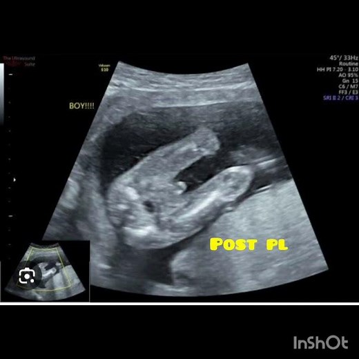 placental position on ultrasound