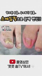 무좀이 방치되어 너무나도 두꺼워진 발톱.. 스케일링으로 이만큼이나 개선되었다고? #두꺼운발톱 #fungustoenail