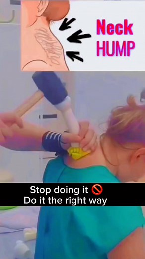 Neck Hump ?😔 Spinal Curvature Disorder ? 😩 Try this his at home ✅ Dm for online Yoga classes Yogvidya #healthy #yoga #yogaflow #yogalove #yogainspiration #yogapractice #neckpain #shoulderpain #backpainrelief #healthcare #ayurveda #trend #facebookreels #trendingreels #viralreelsfb #virals #reelsfb | Yogvidya