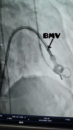 Opening the valve:BMV Procedure