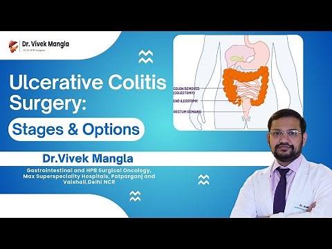 Ulcerative Colitis Surgery Explained | Stages, Procedure & Recovery | Dr. Vivek Mangla