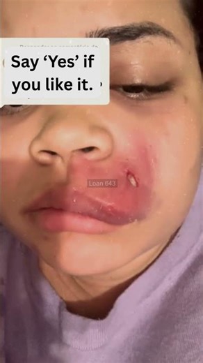 🔥Deep Blackheads, Milia & Whitehead Removal pimple popping New| Big Cystic Acne Extraction#1260 2026