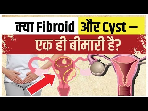 महिलाओं की दो बड़ी समस्याएँ – Fibroid और Cyst, आखिर फर्क क्या है?