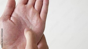 Close up view on cracked skin of palm. Problem skin of palms of adult person. Dermatological disease on hands.