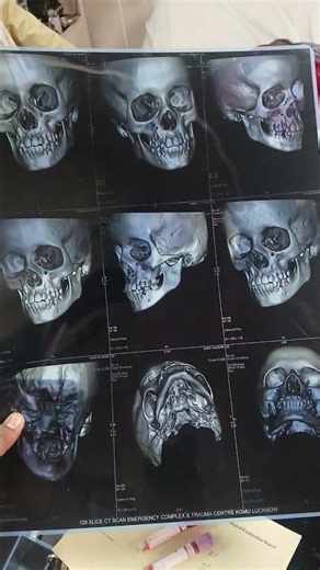 Facial CT Scan