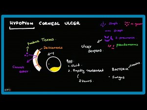 Hypopyon Corneal Ulcer