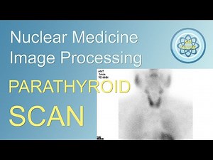 Parathyroid scan Processing, in nuclear medicine