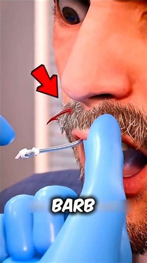 Fish Hook Stuck in Your Skin? Don't Pull It Out😨