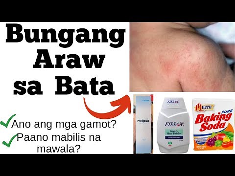 BUNGANG ARAW SA BATA | SINTOMAS | ANO ANG GAMOT | PAANO MABILIS NA MAWALA