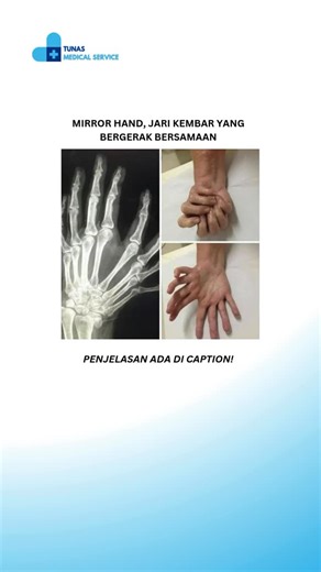 Tunas Medical Service on Instagram: "Foto ini menunjukkan kondisi langka yang disebut Ulnar dimelia, atau lebih dikenal dengan istilah mirror hand. Kelainan bawaan ini ditandai dengan tidak adanya tulang radius (tulang lengan bagian luar), sementara tulang ulna (bagian dalam) justru terduplikasi, begitu juga dengan tulang pergelangan, telapak, hingga ruas-ruas jari. Yang paling unik, pergerakan jari-jari tangan ini bisa “bercermin”! Ketika satu jari bergerak, jari yang berlawanan akan ikut berge