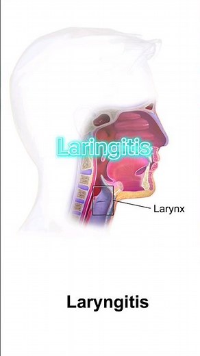 LARINGITIS - DEFINICIÓN MÉDICA | Interpretación Consecutiva Medica