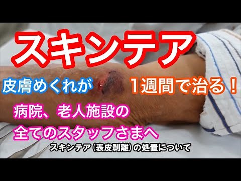 「スキンテア(皮膚めくれ)」痛くない魔法の処置方法