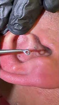 Tag Tool black head Ears #skincare #blackheadremoval
