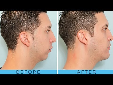jawline exercise for men before and after